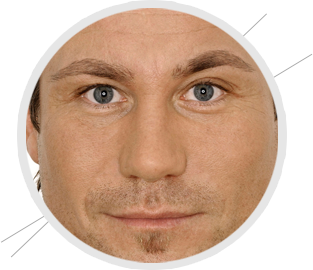 remodelage du nez par injections d'acide hyaluronique